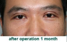 plastic-surgery-blepharoplasty